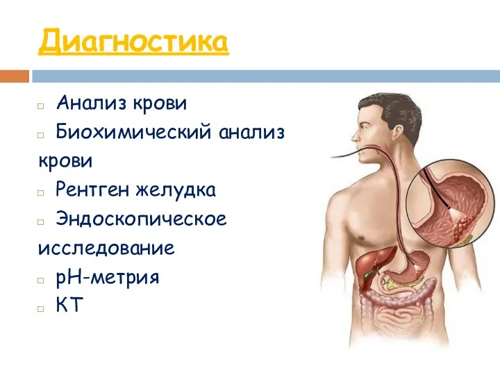 Диагностика Анализ крови Биохимический анализ крови Рентген желудка Эндоскопическое исследование рН-метрия КТ