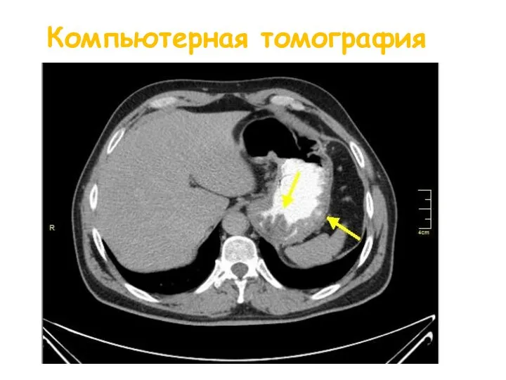 Компьютерная томография