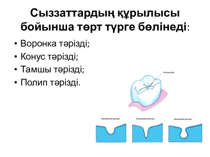 Сыззаттардың құрылысы бойынша төрт түрге бөлінеді: Воронка тәрізді; Конус тәрізді; Тамшы тәрізді; Полип тәрізді.