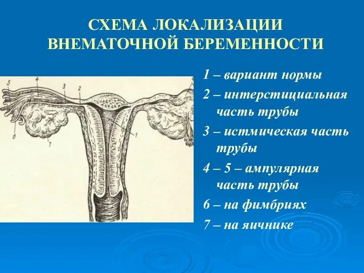 СХЕМА ЛОКАЛИЗАЦИИ ВНЕМАТОЧНОЙ БЕРЕМЕННОСТИ 1 – вариант нормы 2 – интерстициальная часть