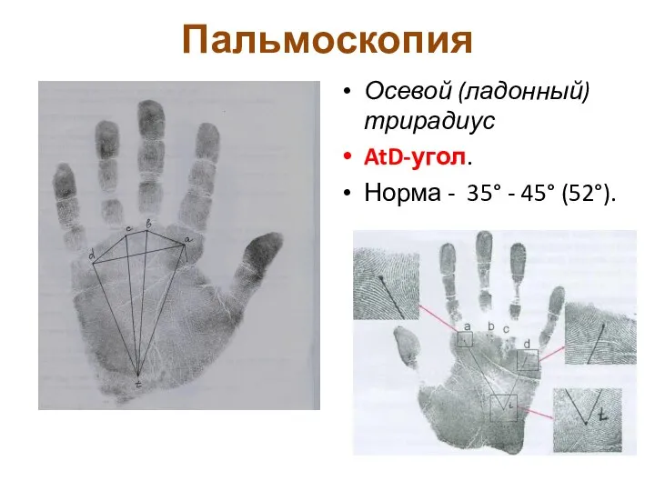 Пальмоскопия Осевой (ладонный) трирадиус AtD-угол. Норма - 35° - 45° (52°).