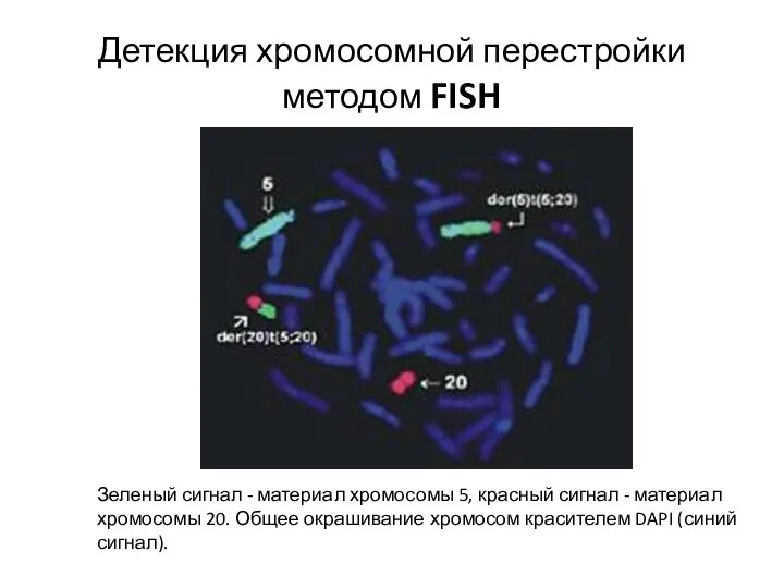 Детекция хромосомной перестройки методом FISH Зеленый сигнал - материал хромосомы 5, красный
