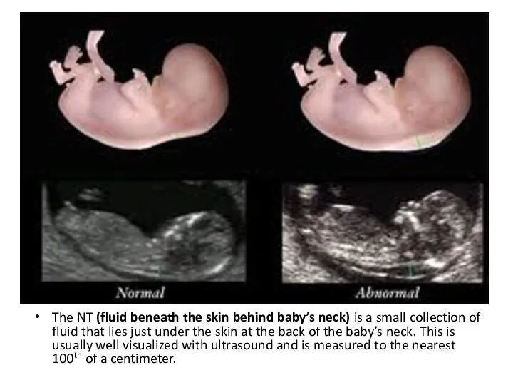 The NT (fluid beneath the skin behind baby’s neck) is a small