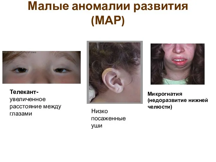 Малые аномалии развития (МАР) Телекант- увеличенное расстояние между глазами Низко посаженные уши Микрогнатия (недоразвитие нижней челюсти)