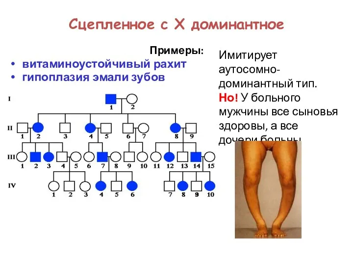 Сцепленное с Х доминантное Примеры: витаминоустойчивый рахит гипоплазия эмали зубов Имитирует аутосомно-доминантный