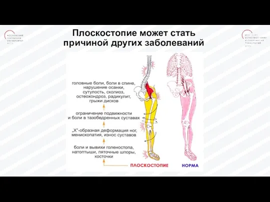 Плоскостопие может стать причиной других заболеваний