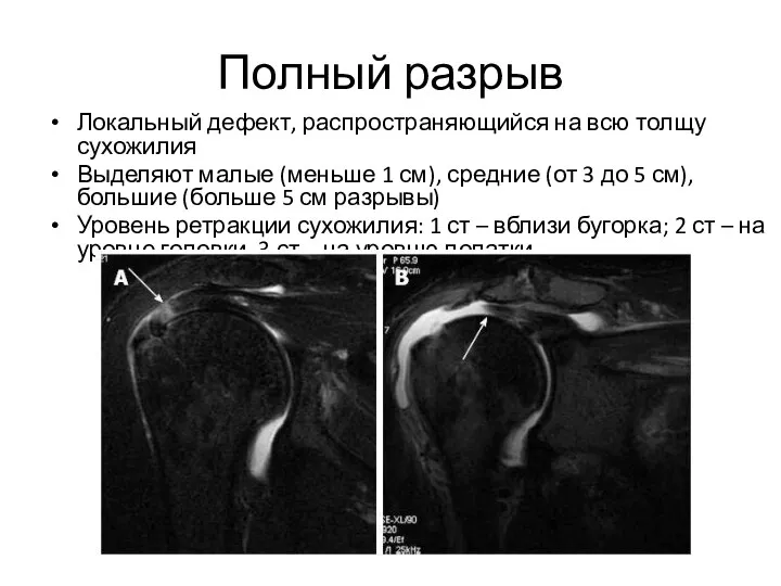 Полный разрыв Локальный дефект, распространяющийся на всю толщу сухожилия Выделяют малые (меньше