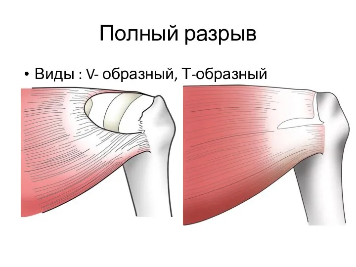 Полный разрыв Виды : V- образный, Т-образный
