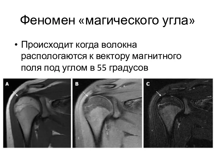 Феномен «магического угла» Происходит когда волокна распологаются к вектору магнитного поля под углом в 55 градусов