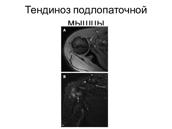 Тендиноз подлопаточной мышцы