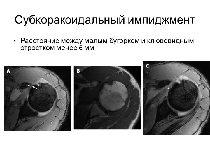 Субкоракоидальный импиджмент Расстояние между малым бугорком и клювовидным отростком менее 6 мм