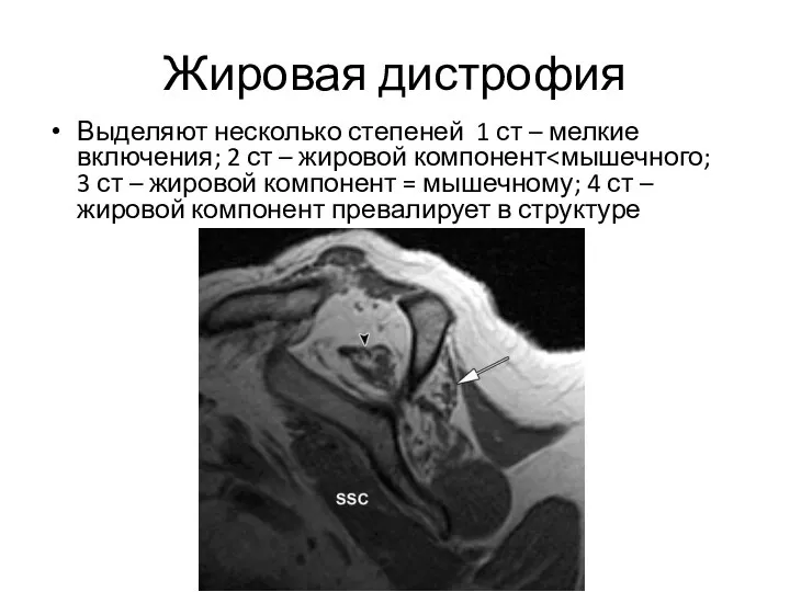 Жировая дистрофия Выделяют несколько степеней 1 ст – мелкие включения; 2 ст – жировой компонент