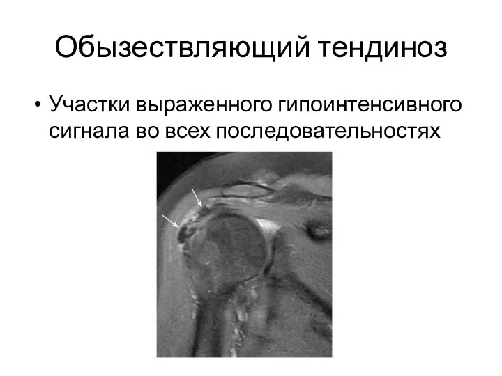 Обызествляющий тендиноз Участки выраженного гипоинтенсивного сигнала во всех последовательностях