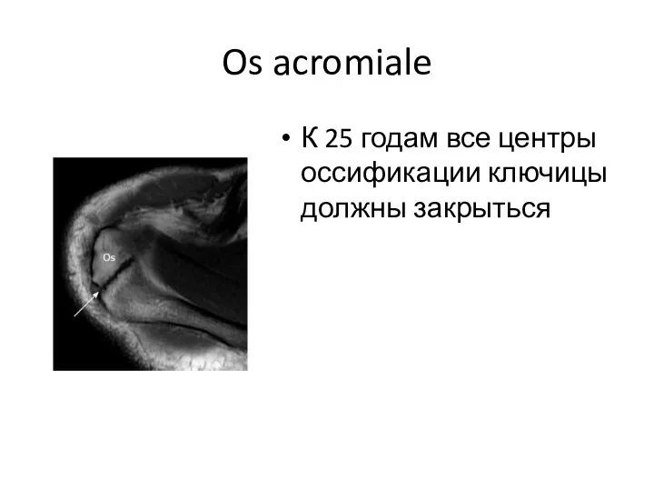 Os acromiale К 25 годам все центры оссификации ключицы должны закрыться