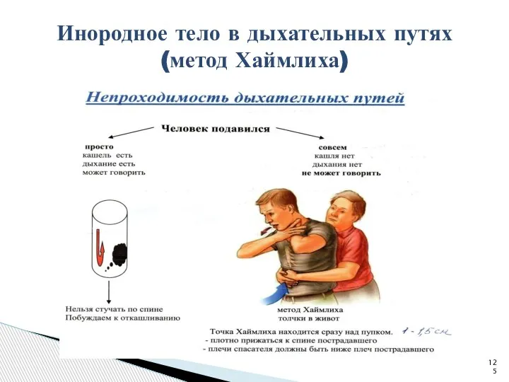 Инородное тело в дыхательных путях (метод Хаймлиха)