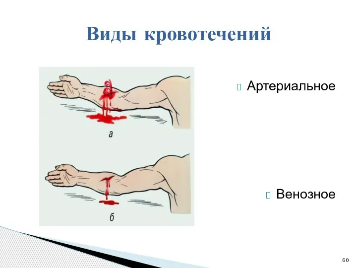 Виды кровотечений Артериальное Венозное