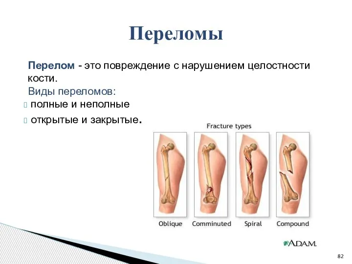Перелом - это повреждение с нарушением целостности кости. Виды переломов: полные и