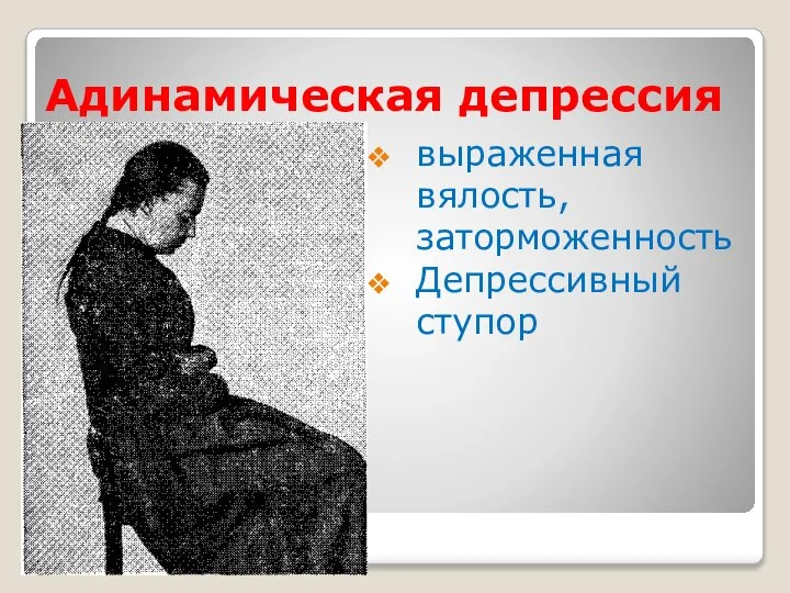 Адинамическая депрессия выраженная вялость, заторможенность Депрессивный ступор