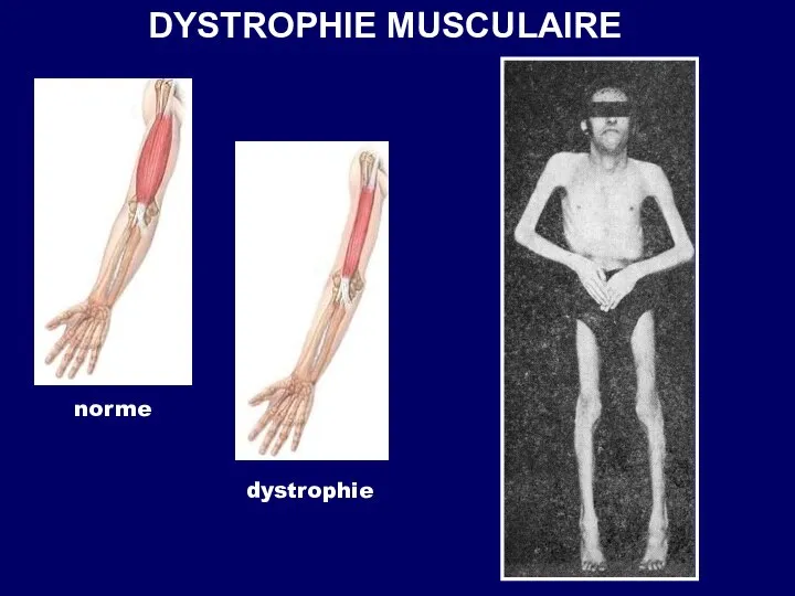 DYSTROPHIE MUSCULAIRE norme dystrophie