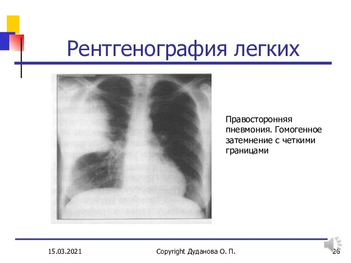 15.03.2021 Copyright Дуданова О. П. Рентгенография легких Правосторонняя пневмония. Гомогенное затемнение с четкими границами