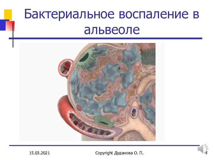 Бактериальное воспаление в альвеоле 15.03.2021 Copyright Дуданова О. П.
