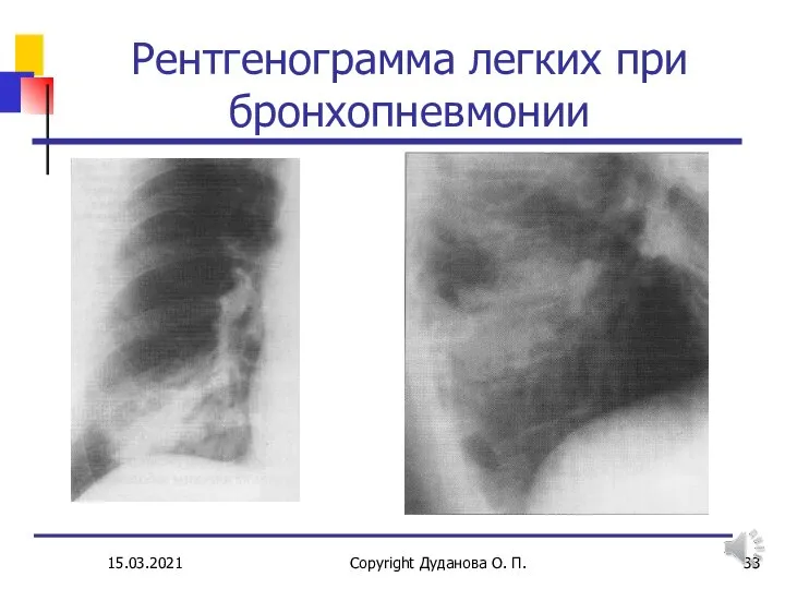 15.03.2021 Copyright Дуданова О. П. Рентгенограмма легких при бронхопневмонии