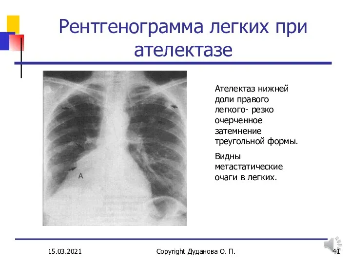 15.03.2021 Copyright Дуданова О. П. Рентгенограмма легких при ателектазе Ателектаз нижней доли