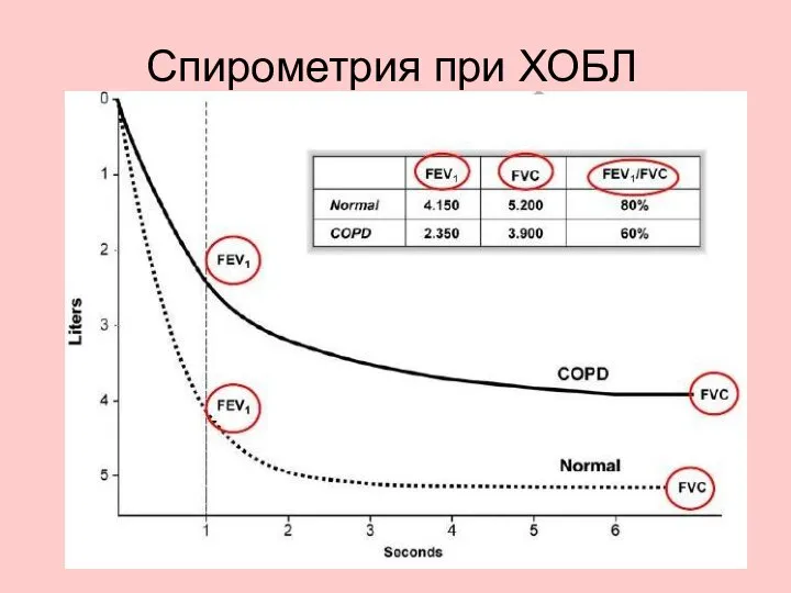 Спирометрия при ХОБЛ