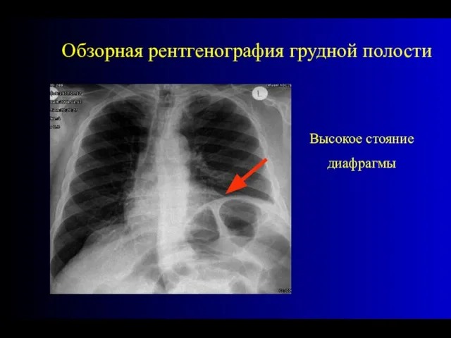 Высокое стояние диафрагмы Обзорная рентгенография грудной полости