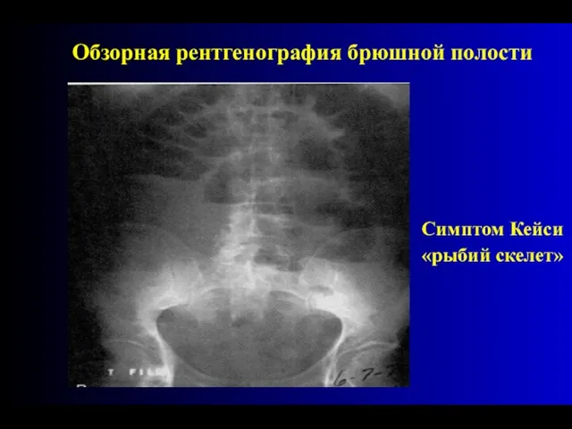 Симптом Кейси «рыбий скелет» Обзорная рентгенография брюшной полости