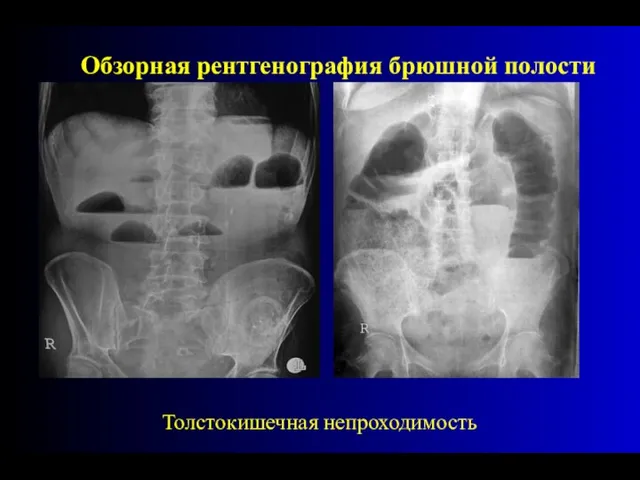 Толстокишечная непроходимость Обзорная рентгенография брюшной полости