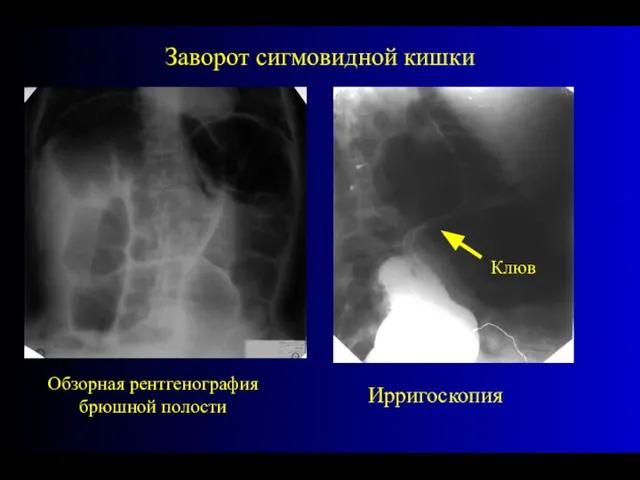 Заворот сигмовидной кишки Обзорная рентгенография брюшной полости Ирригоскопия Клюв