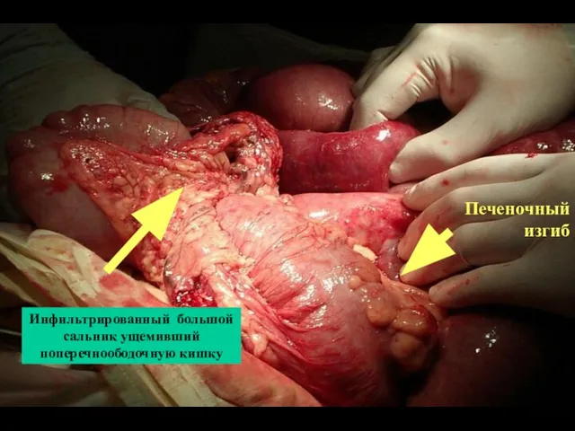 Инфильтрированный большой сальник ущемивший поперечноободочную кишку Печеночный изгиб