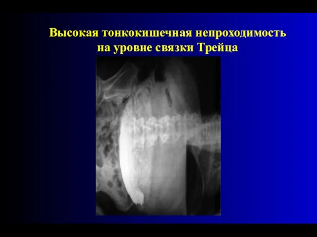 Высокая тонкокишечная непроходимость на уровне связки Трейца