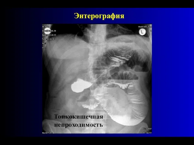 Энтерография Тонкокишечная непроходимость