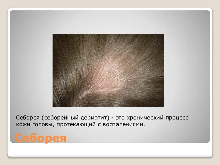 Себорея Себорея (себорейный дерматит) - это хронический процесс кожи головы, протекающий с воспалениями.