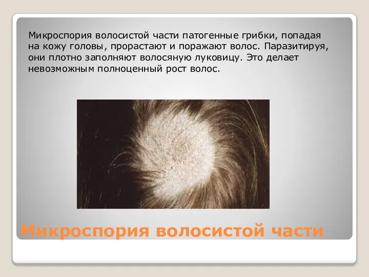 Микроспория волосистой части Микроспория волосистой части патогенные грибки, попадая на кожу головы,