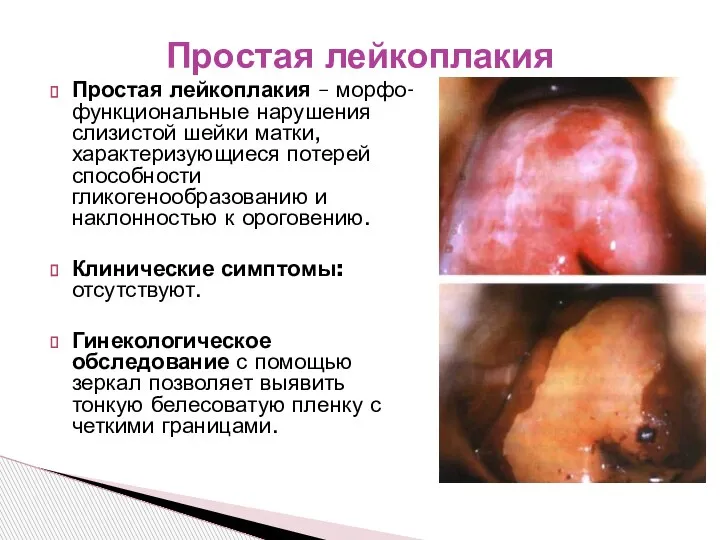 Простая лейкоплакия – морфо-функциональные нарушения слизистой шейки матки, характеризующиеся потерей способности гликогенообразованию