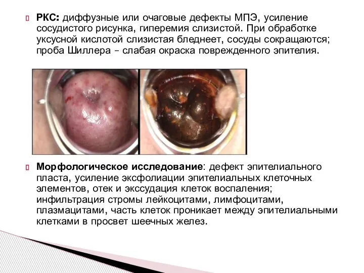 РКС: диффузные или очаговые дефекты МПЭ, усиление сосудистого рисунка, гиперемия слизистой. При