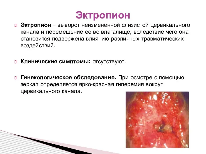 Эктропион – выворот неизмененной слизистой цервикального канала и перемещение ее во влагалище,