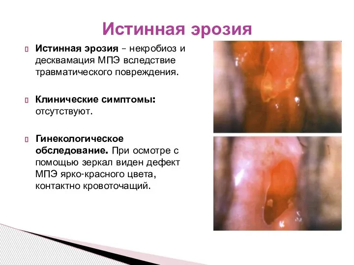 Истинная эрозия – некробиоз и десквамация МПЭ вследствие травматического повреждения. Клинические симптомы: