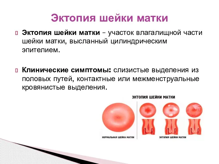 Эктопия шейки матки – участок влагалищной части шейки матки, высланный цилиндрическим эпителием.