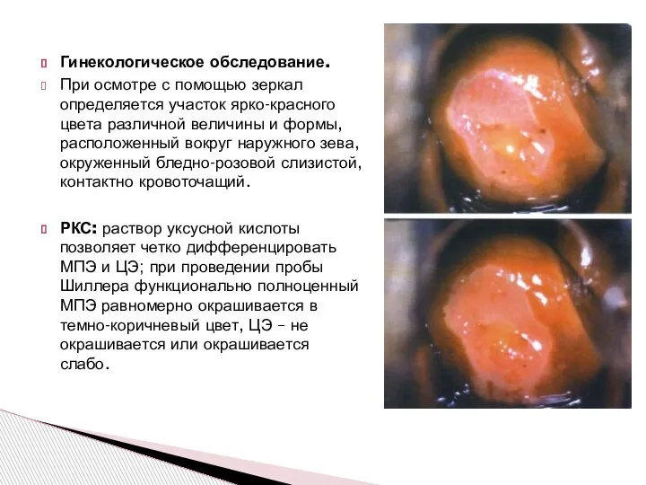 Гинекологическое обследование. При осмотре с помощью зеркал определяется участок ярко-красного цвета различной