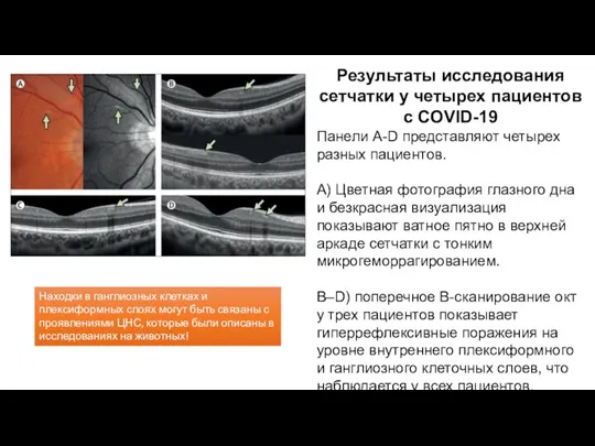 Результаты исследования сетчатки у четырех пациентов с COVID-19 Панели A-D представляют четырех