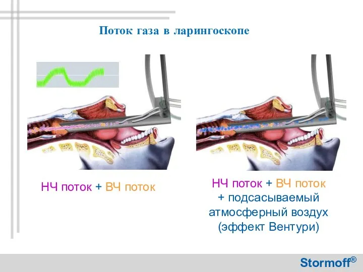 Поток газа в ларингоскопе Stormoff®