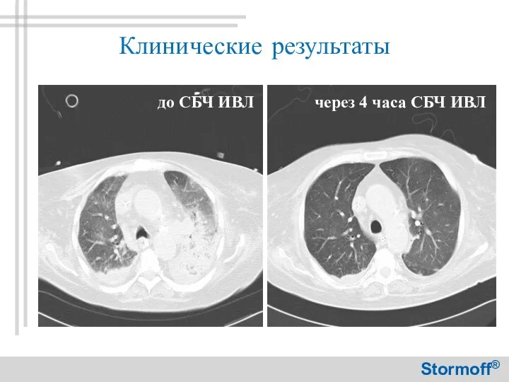 Клинические результаты до СБЧ ИВЛ через 4 часа СБЧ ИВЛ Stormoff®