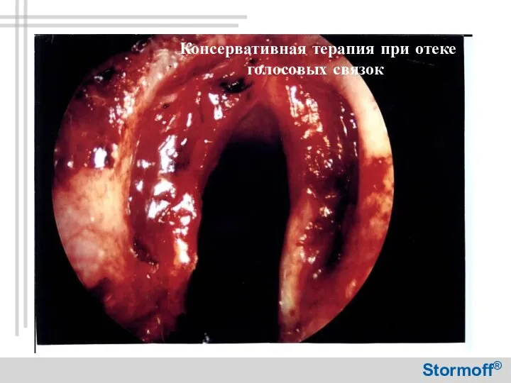 Консервативная терапия при отеке голосовых связок Stormoff®
