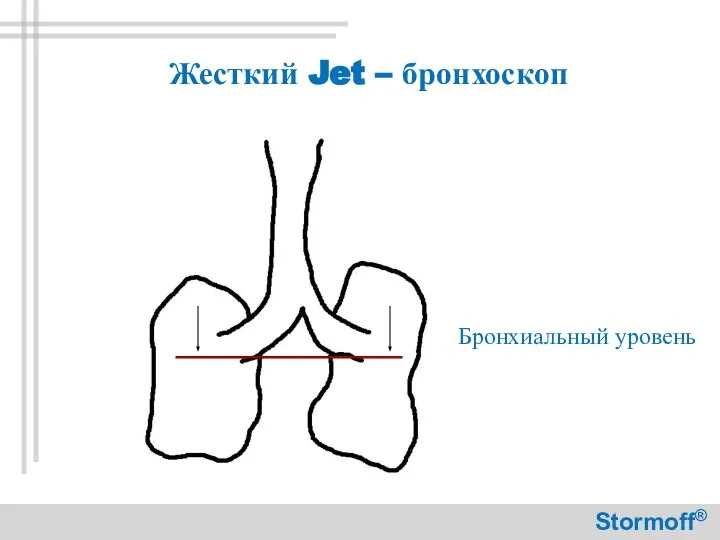 Жесткий Jet – бронхоскоп Бронхиальный уровень Stormoff®