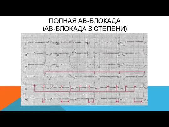 ПОЛНАЯ АВ-БЛОКАДА (АВ-БЛОКАДА 3 СТЕПЕНИ)