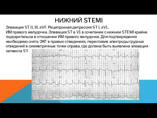 НИЖНИЙ STEMI Элевация ST II, III, aVF. Реципрокная депрессия ST I, aVL.